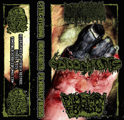 Cystic Hygroma : Cystic Hygroma - Endocarditis - Pulmonary Fibrosis